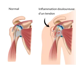 Inflammation tendon épaule