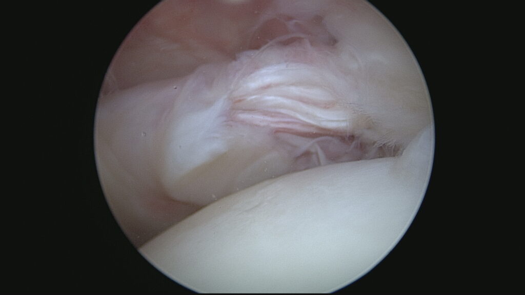 Lésion subscapularis (Vue extraarticulaire)