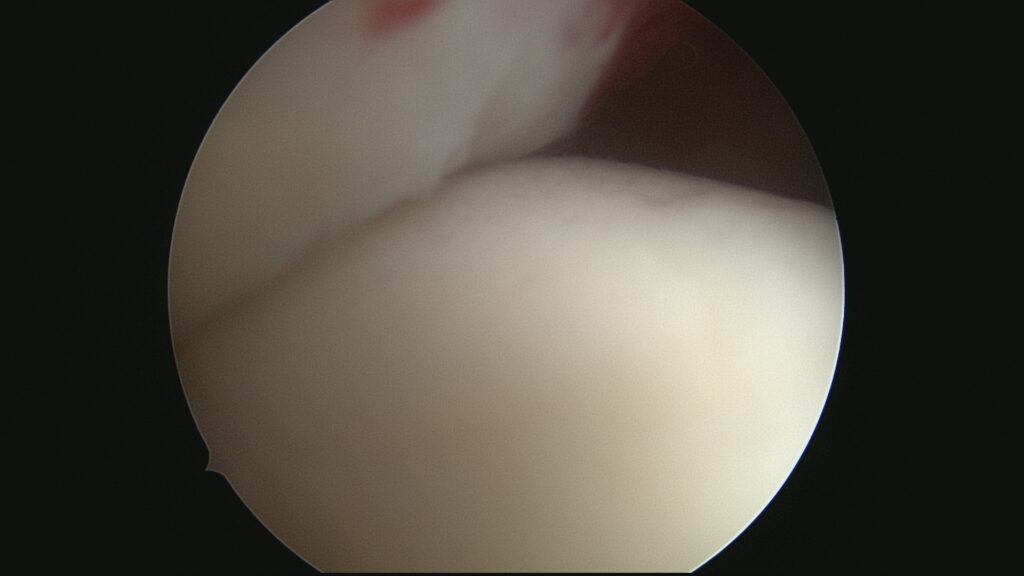 Réinsertion coiffe (Vue endoarticulaire)