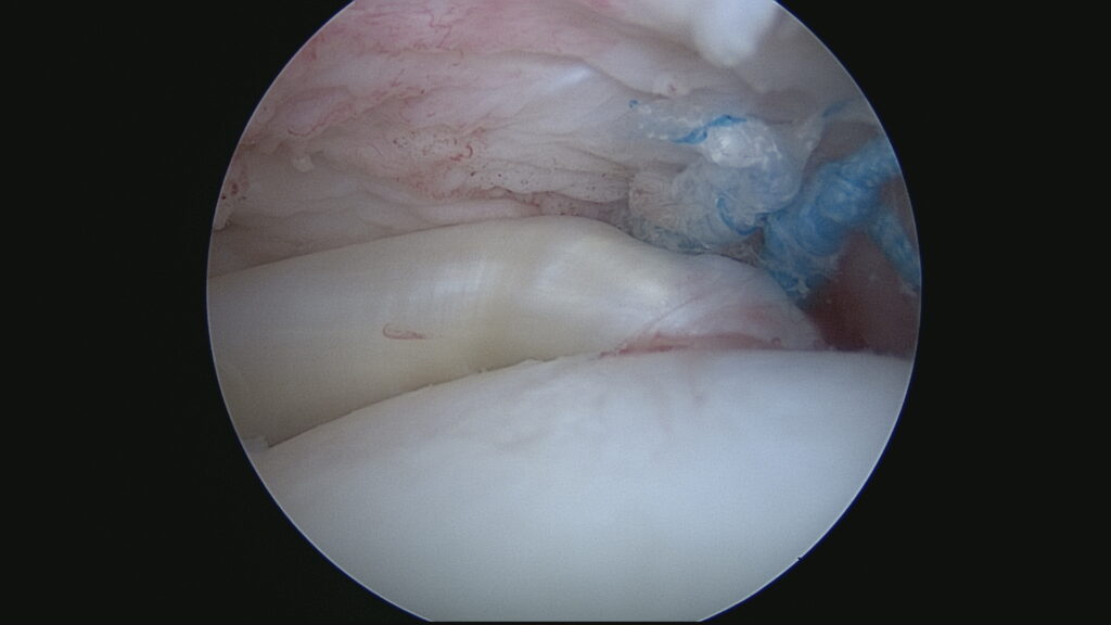 Réinsertion subscapularis (Vue endoarticulaire)
