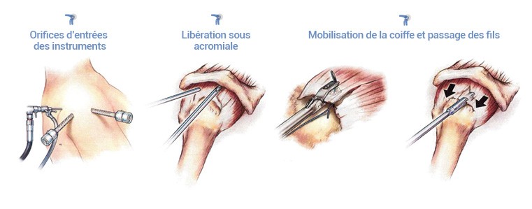 Réparation de la coiffe des rotateurs à nice